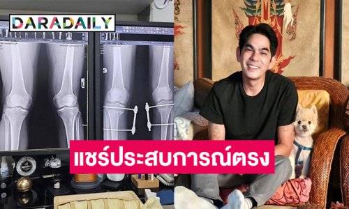 “บิ๊ก ศรุต” เผยภาพฟิล์มเอ็กซ์เรย์ แชร์ประสบการณ์ผ่าตัดขาฉิ่ง