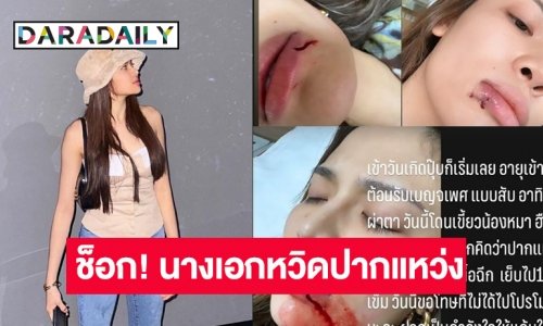 ระทึก! นางเอกดังวิกหมอชิตหวิดเสียโฉม โดนหมากัดเย็บกว่า 10 เข็ม