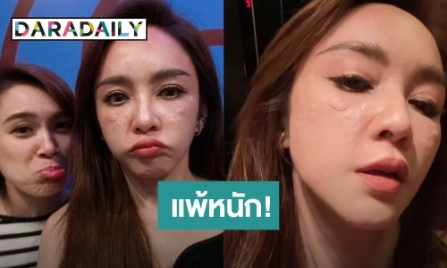 โอ้โห! “เป้ย ปานวาด” แพ้แอลกอฮอล์หนัก ตุ่มผื่นขึ้นหน้า
