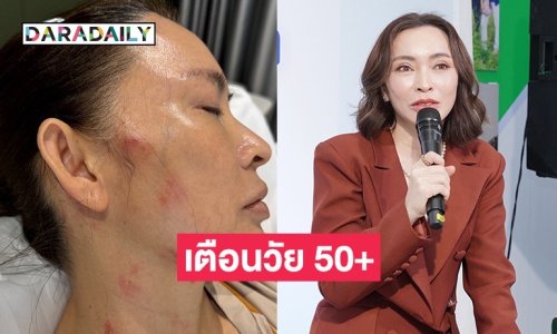 “ปุ้ย พิมลวรรณ” แชร์ประสบการณ์หลังเป็นโรคงูสวัด เตือนวัย 50+ อันตรายกว่าที่คิด!