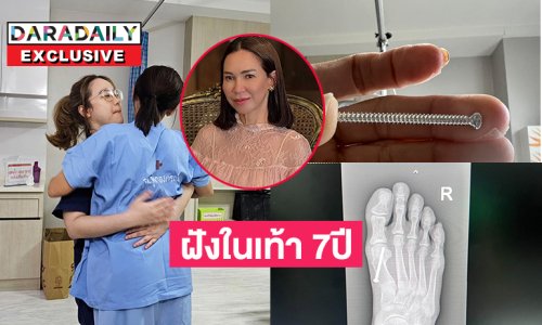 ดารารุ่นใหญ่ตัดสินใจผ่าหัวสกรูออกหลังฝังในเท้า 7 ปี