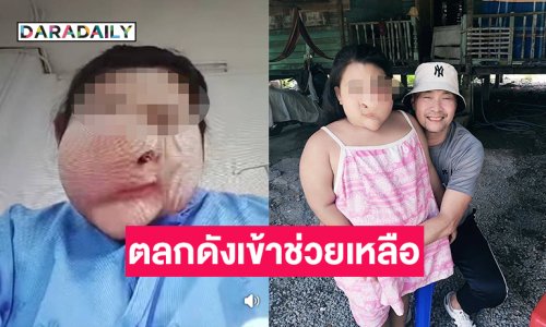 ตลกดังเข้าช่วยเหลือเด็กหญิงใบหน้าผิดรูปเข้ารับการผ่าตัด