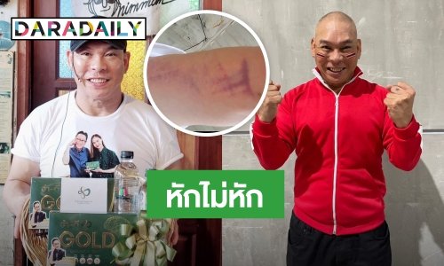 “โหน่ง ชะชะช่า” โชว์แผลรอยแดงช้ำ ลุ้น! หักไม่หัก