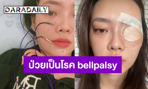 ปีนี้เอาเรื่องสุด! “พรอยมน” โพสต์เล่าละเอียดป่วยเป็นโรค bellpalsy 