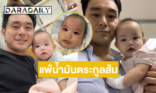 ลูกชายดารายุค90 ป่วยโรคชื่อประหลาด “แพ้น้ำมันตระกูลส้ม”