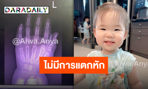 “หม่ามี้ออย” แจ้งอาการ “น้องอัญญา” หลังถูกประตูหนีบนิ้วนางข้างซ้าย ปลอดภัยหายห่วง