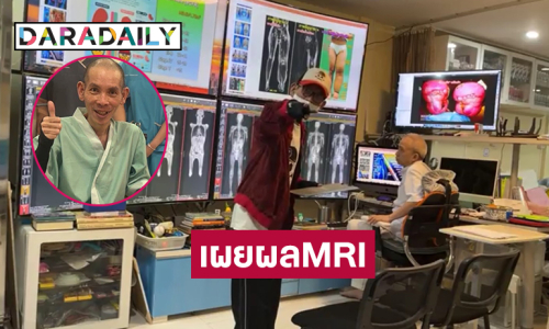 ไลฟ์สดกับแพทย์เผยผลMRI ของศิลปินป่วยตุ่มน้ำพองครั้งแรก