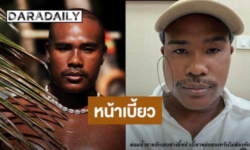 “รัศมีแข” หน้าเบี้ยวเหตุต่อมน้ำลายอักเสบ