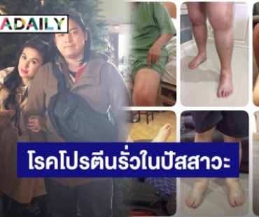 “ตุ๊กตา อุบลวรรณ” เล่าแฟนป่วยเป็นโรคโปรตีนรั่วในปัสสาวะ ขาบวมน้ำหนักขึ้นเกือบ100โล